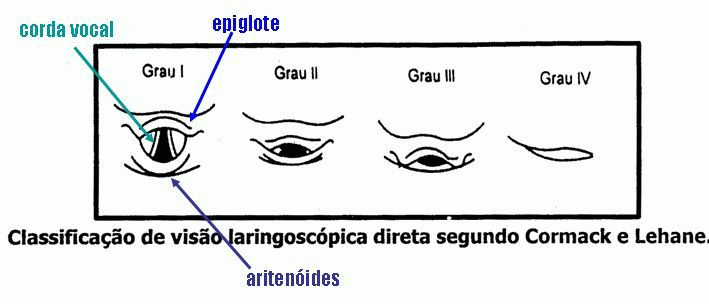 laryngoscopic view grade