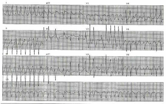 heart attack ecg. the ECG may exceed 250-300