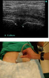 Ultrasound for Pubic Widening from JEM