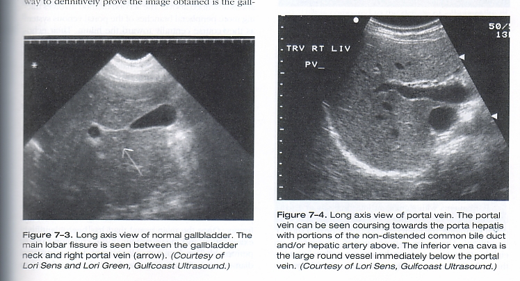 gallbladder ultrasound transverse